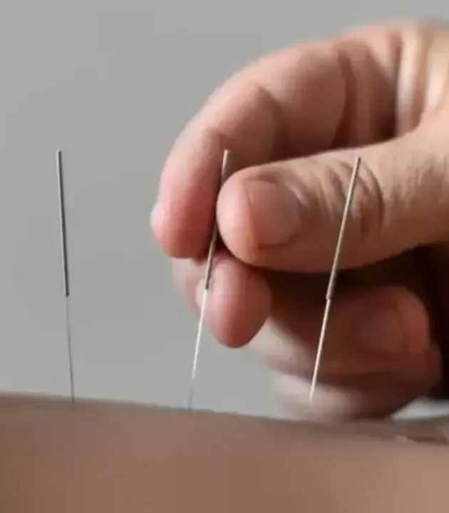 Close-up of a clinician placing thin dry needles into a patient&rsquo;s muscle